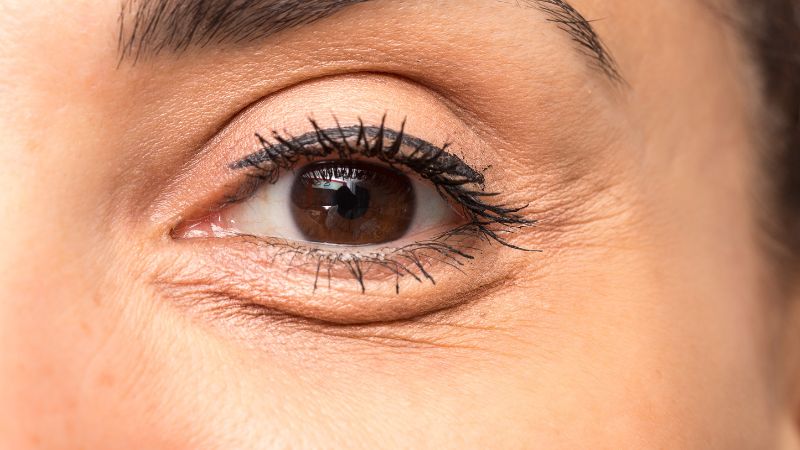 Eye bag on female face